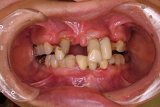 歯周病例1